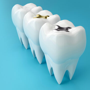 Dental Fillings: A Painless Solution for Cavity Repair