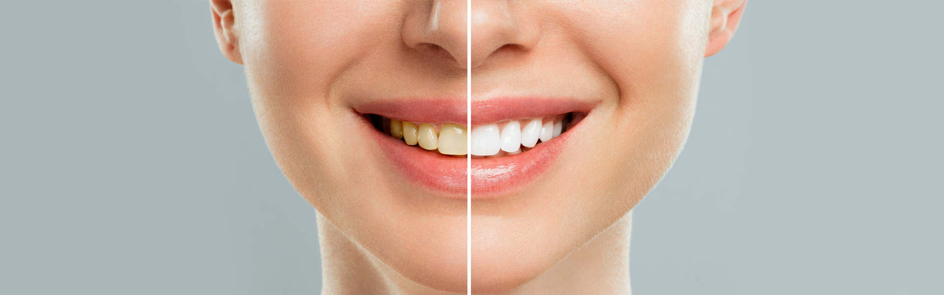 How to Get Rid of Yellow Teeth Overnight: Expert Tips You Should Know