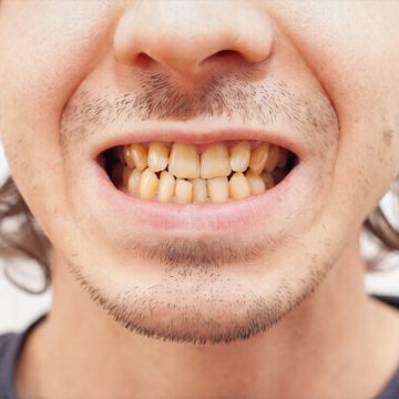 How to Get Rid of Yellow Plaque on Teeth?