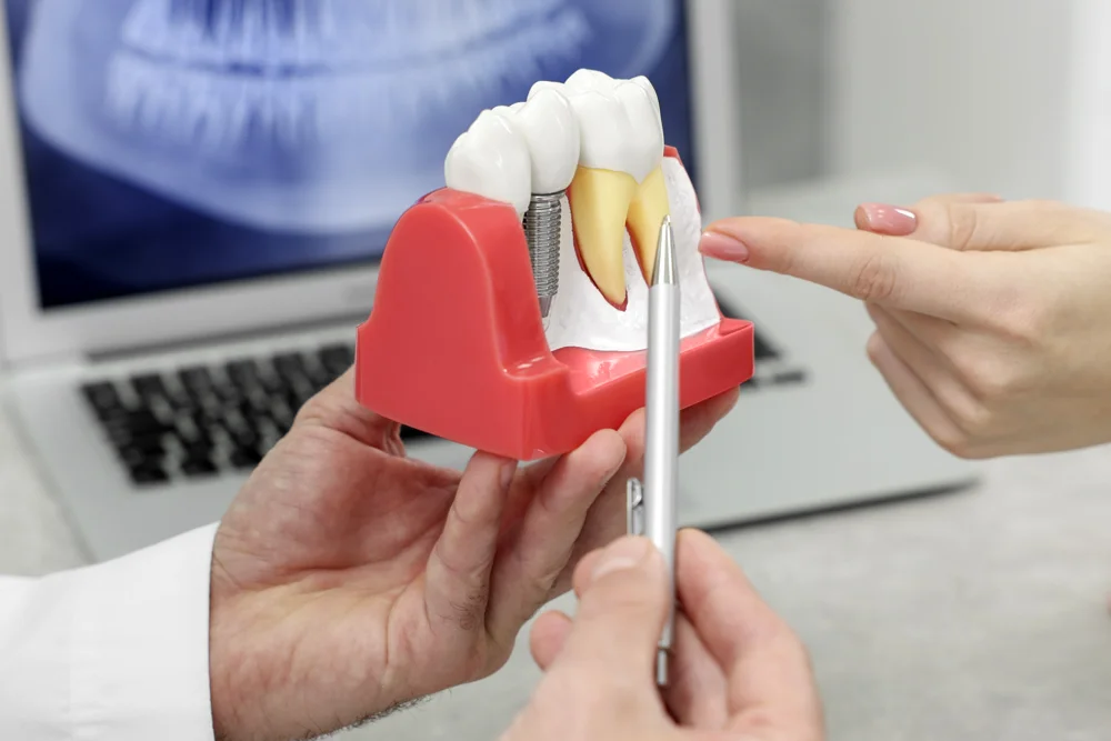 Dental Implants
